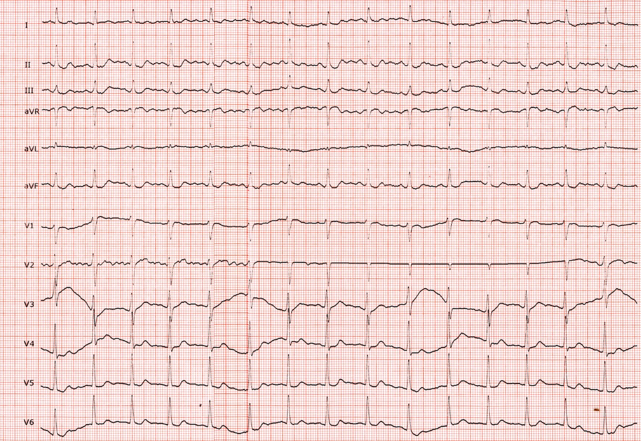 Surgical Milestone Philadelphia’s First Micra AV Pacemaker Implanted